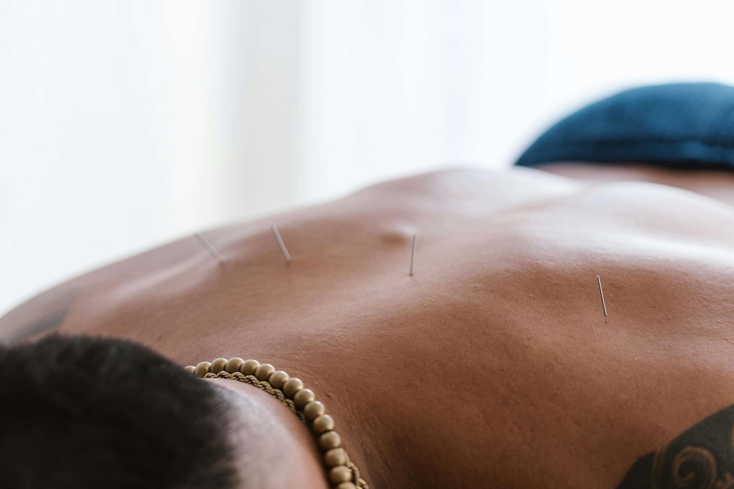 Acupuncture Treatment Pain Relief